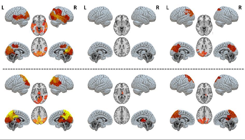 Response differences in brain circuits when broadcasting (top row) or receiving signals (bottom row). Left: healthy controls; Middle: unresponsive wakefulness; Right: minimally conscious