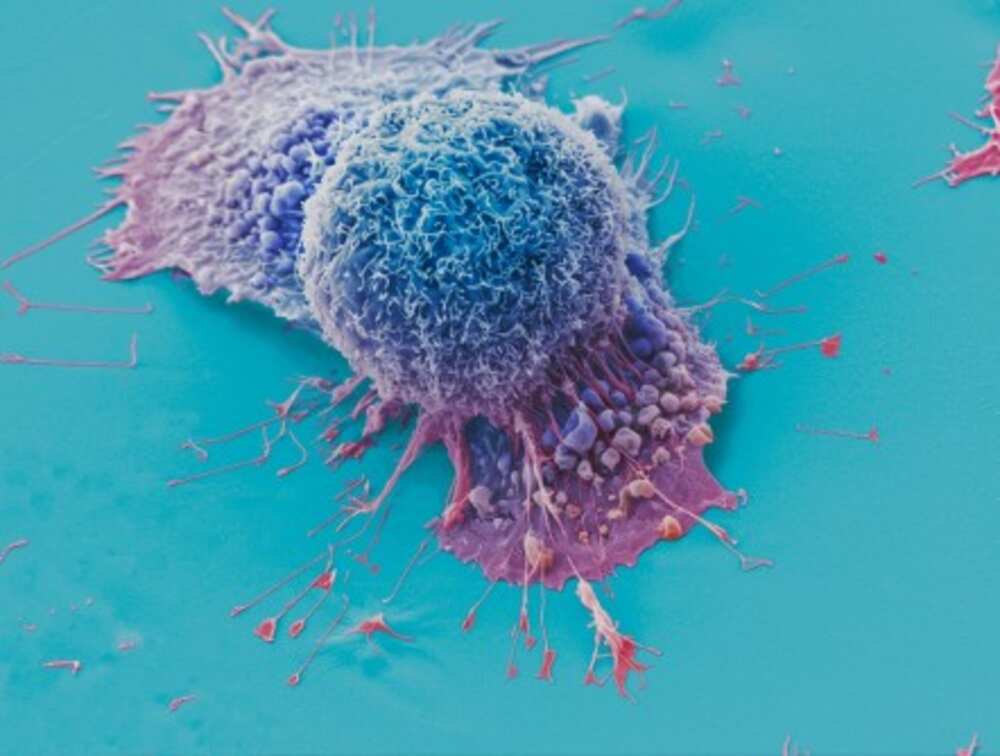 This is a false-color scanning electron micrograph that shows lung cancer cells grown in culture. The image is courtesy of Anne Weston. A new AI tool named PERCEPTION is helping predict patients' response to various therapies by utilizing data at the level of individual cells.