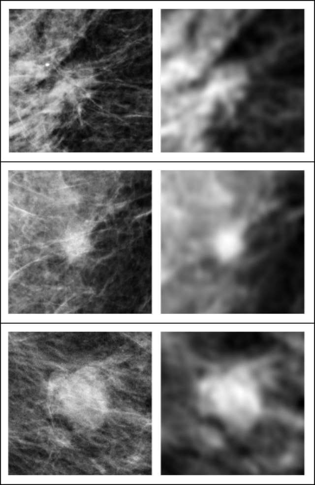 In these three examples of soft tissue lesions, the images are unperturbed on the left column and blurred on the right column. The AI system was sensitive to the blurring, while the radiologists were not. This showed that the AI system relies on details in soft tissue lesions that are considered irrelevant by the radiologists. Image courtesy of Taro Makino, NYU’s Center for Data Science