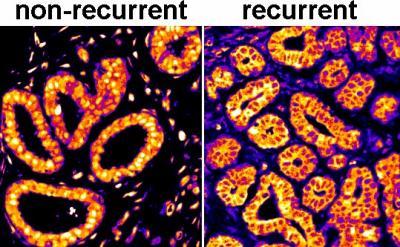 CAPTION Micrographs from samples of women who experienced and did not experience cancer recurrences.  CREDIT Dr. Howard R. Petty