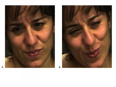 Which expression do you think shows real pain? Attempts to fake expressions of pain typically involve the same facial muscles that are contracted during real pain. There is no telltale facial muscle whose presence or absence would indicate real or faked pain. The difference is in the dynamics. Human observers are at chance for telling them apart. The machine learning and computer vision system described by Bartlett et al. detects faked pain significantly better than humans. The system detects distinctive dynamic features of expression missed by humans. Spontaneous and deliberate facial movement is controlled by distinct motor pathways that differ in their dynamics. By revealing the dynamics of facial action through machine vision systems, the approach in Bartlett et al has the potential to elucidate behavioral fingerprints of neural control systems involved in emotional signaling. The real expression of pain is image B on the right.   Credit: Kang Lee, Marian Bartlett