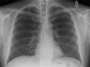 chest x ray credit stillwaterising 132307484814796746 c7147