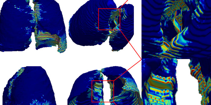 Figure depicting regions of shape differences between COVID-19 patients with mild and severe disease. The blue regions indicate areas in the lung with no shape differences between the patients and yellow to red indicates areas with significant differences in the lung shape between the two.