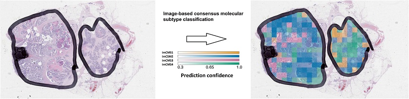 The image-based consensus molecular subtypes (imCMS) model can be used to predict the molecular classification of each individual image region in patient tumor samples. This process takes just a few minutes and requires no further patient material.