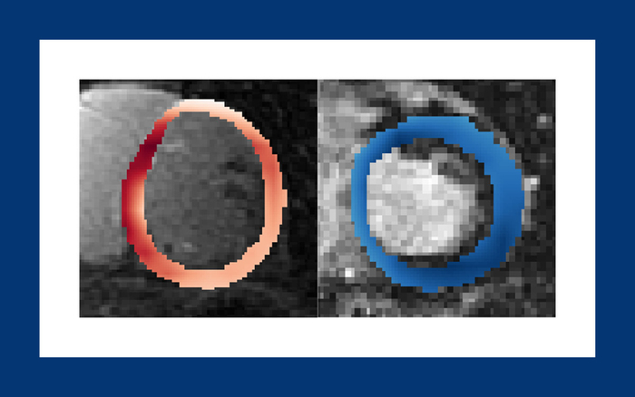 A first-of-its-kind algorithm, using raw MRI images, can predict if and when a patient will have a lethal episode of heart arrhythmia. It detected high risk in the heart circled in red.