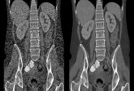 The image at left demonstrates filtered back projection (FBP) image reconstruction using conventional CT imaging, and, at right, an image reconstruction using Veo. Veo, developed by Purdue University, University of Notre Dame and GE Healthcare, is a new CT scanning technology that enables physicians to diagnose patients with high clarity images at previously unattainable low radiation dose levels. (Image provided by Purdue University) 